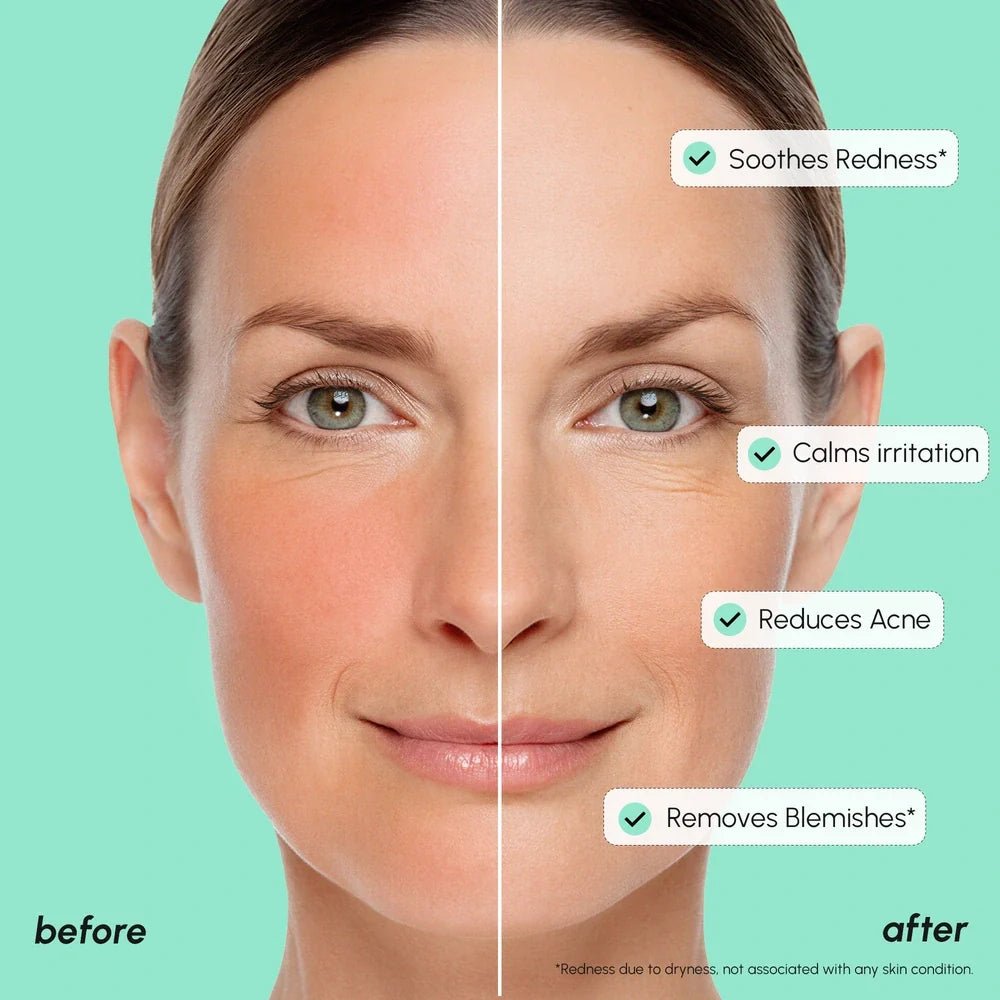 Redness Soothing Azelaic Acid Serum - Shop PiecebyPiece