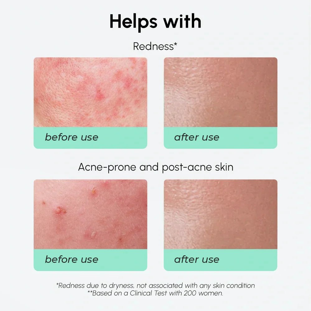 Redness Soothing Azelaic Acid Serum - Shop PiecebyPiece